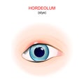 Stye. eye with hordeolum on the upper eyelid Royalty Free Stock Photo