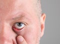 Stye in the eye Royalty Free Stock Photo