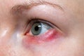 Stye on the girl`s eye, inflammation of the hair bulb on the eyelids, hordeolum, bacterial infection of an oil grand