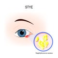 Stye. Human`s Eye and bacteria that cause it Royalty Free Stock Photo