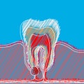 Stylized hatching of dental disease with a point of pain and inflammation. Medical illustration of tooth root inflammation, tooth