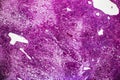 Subacute severe hepatitis, light micrograph Royalty Free Stock Photo