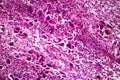 Subacute severe hepatitis, light micrograph Royalty Free Stock Photo