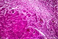 Subacute severe hepatitis, light micrograph Royalty Free Stock Photo