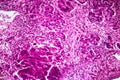 Subacute severe hepatitis, light micrograph Royalty Free Stock Photo