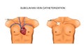 Subclavian vein catheterization