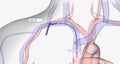 The subclavian vein is one of the most common sites used for the placement of CVCs Royalty Free Stock Photo