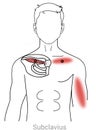 Subclavius: Managing chest and arm pain originating from myofascial trigger points in the subclavius muscle