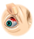 Subconjunctival hemorrhage Royalty Free Stock Photo