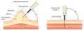 Subcutaneous and intramuscular injection techniques