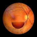 A subhyaloid hemorrhage on the retina as observed during ophthalmoscopy, 3D illustration Royalty Free Stock Photo