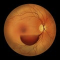 A subhyaloid hemorrhage on the retina as observed during ophthalmoscopy, an illustration Royalty Free Stock Photo