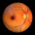 A submacular hemorrhage on the retina as observed during ophthalmoscopy, 3D illustration Royalty Free Stock Photo