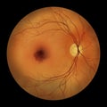 A submacular hemorrhage on the retina as observed during ophthalmoscopy, an illustration