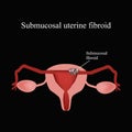 Submucosal fibroids. Endometriosis. Infographics. Vector illustration on a black background