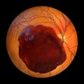 A subretinal hemorrhage as observed during ophthalmoscopy, 3D illustration Royalty Free Stock Photo