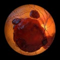 A subretinal hemorrhage as observed during ophthalmoscopy, 3D illustration Royalty Free Stock Photo