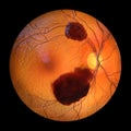 A subretinal hemorrhage as observed during ophthalmoscopy, 3D illustration Royalty Free Stock Photo