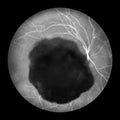 A subretinal hemorrhage as observed during ophthalmoscopy, an illustration Royalty Free Stock Photo