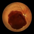 A subretinal hemorrhage as observed during ophthalmoscopy, an illustration Royalty Free Stock Photo