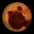 A subretinal hemorrhage as observed during ophthalmoscopy, an illustration Royalty Free Stock Photo