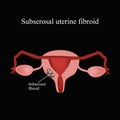 Subserous uterine fibroids. Endometriosis. Infographics. Vector illustration on a black background Royalty Free Stock Photo