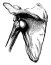 Subspinous Dislocation of the Humerus, vintage illustration