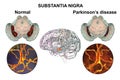 Substantia nigra of the midbrain and its dopaminergic neurons in normal state and in Parkinson's disease, 3D Royalty Free Stock Photo