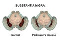 Substantia nigra in norm and in Parkinson`s disease Royalty Free Stock Photo