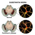 Substantia nigra in norm and in Parkinson`s disease
