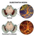 Substantia nigra in norm and in Parkinson`s disease