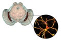 Substantia nigra in Parkinson`s disease