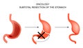 Subtotal resection of the stomach.