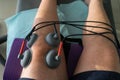 Suction cups applied to a knee in physiotherapy