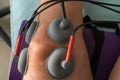 Suction cups applied to a knee in physiotherapy Royalty Free Stock Photo
