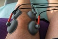 Suction cups applied to a knee in physiotherapy
