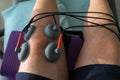 Suction cups applied to a knee in physiotherapy Royalty Free Stock Photo