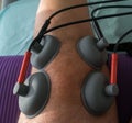 Suction cups applied to a knee in physiotherapy Royalty Free Stock Photo