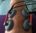 Suction cups applied to a knee in physiotherapy