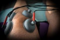 Suction cups applied to a knee in physiotherapy Royalty Free Stock Photo