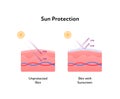 Sun protection medical infographic. Vector flat illustration. Skin layers with uva and uvb arrows. Protected with sunscreen and