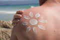 Sunburn Royalty Free Stock Photo