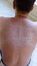 Sunburn on the back and neck of a man, skin peeling and peeling, red spots, a painful condition of a person Royalty Free Stock Photo