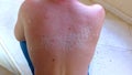 Sunburn on the back and neck of a man, skin peeling and peeling, red spots, a painful condition of a person Royalty Free Stock Photo