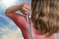Sunburn concept. Young woman with red sunburned skin on her back