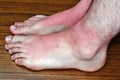 Sunburn on the feet Royalty Free Stock Photo