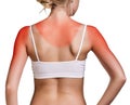 Sunburn female shoulder Royalty Free Stock Photo