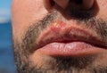 Sunburn on man lips closeup. Sun burn or bacterial infection on skin. Skin medical problem. Skin inflammation