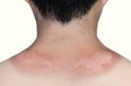 Sunburn peeling discoloration or sun burn dermatitis in the upper back Royalty Free Stock Photo