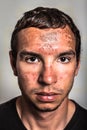 Sunburn skin on male face Royalty Free Stock Photo